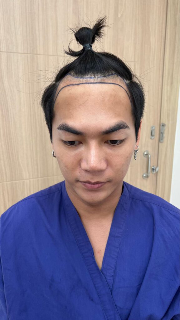 ปลูกผม FUE By Siraikorn Clinic