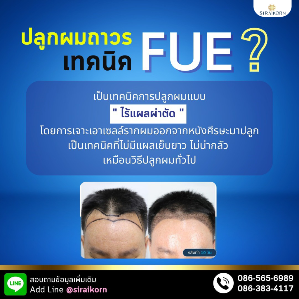 ปลูกผมFUE