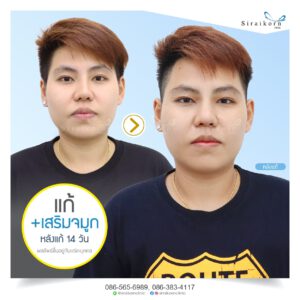 รีวิว แก้จมูก